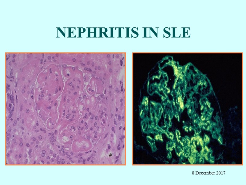 NEPHRITIS IN SLE 8 December 2017